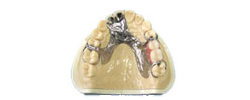 金属床義歯　イメージ