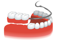 歯が数本抜けた場合の従来の治療