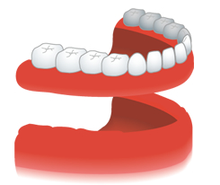 歯が全部抜けた場合の従来の治療